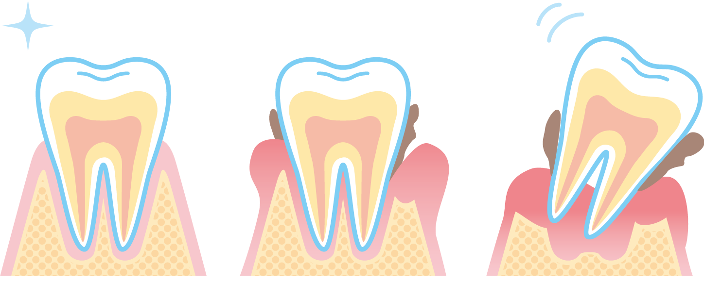 虫歯だけでなく歯周病にも注意しましょう